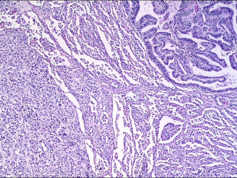 RCC Histology Unclassified - KCCure