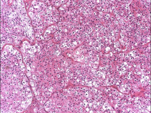 RCC Histology chromophobe - KCCure