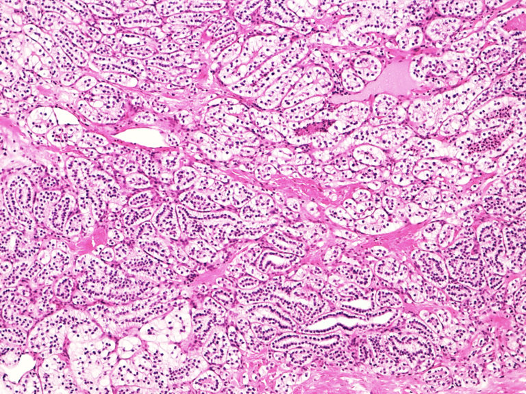 rcc-histology-clear-cell-papillary-kccure