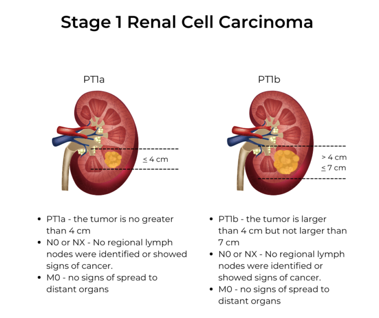 kidney-cancer-stages-kccure-kidney-cancer-diagnosis-stages