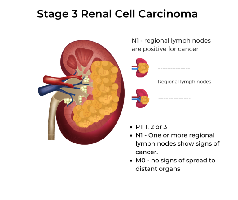 Kidney Cancer Stages Kccure Kidney Cancer Diagnosis Stages