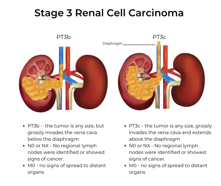 kidney-cancer-stages-kccure-kidney-cancer-diagnosis-stages